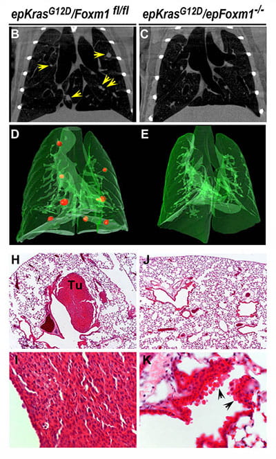 Genetic inactivation of the Foxm1 gene in respiratory epithelial cells of mouse lungs prevents development of lung tumors driven by the oncogenic KrasG12D.